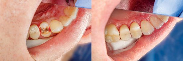 Emberi fogak közelről helyreállítása a töltés alatt. Esztétikai fogászat fogalmát - Fotó, kép