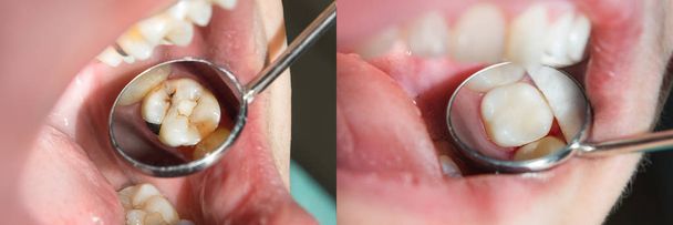 Γκρο πλαν ανθρώπινα δόντια κατά τη διάρκεια της αποκατάστασης της πλήρωσης. Η έννοια της αισθητικής οδοντιατρικής - Φωτογραφία, εικόνα