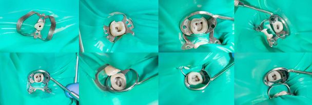 closeup αντιμετωπίζονται ανθρώπινο δόντι σε ένα σάπιο κλινική οδοντικό πλήρωσης. Καθαρισμός και κανάλια με τη χρήση του καουτσούκ φράγμα σύστημα σφραγίδων και σταδιοποίηση - Φωτογραφία, εικόνα