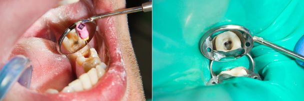 Ενδοδοντική θεραπεία δοντιών close-up. Καθάρισμα των ριζών των δοντιών και τους γέμιση. Η έννοια της σύγχρονης τεχνολογίας στην οδοντιατρική κλινική - Φωτογραφία, εικόνα