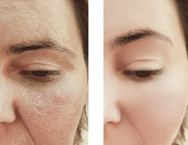 donna rughe viso prima e dopo le procedure
 - Foto, immagini