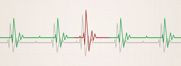 banner medicinale che illustra il battito cardiaco irregolare su ecg durante il monitor
 - Foto, immagini