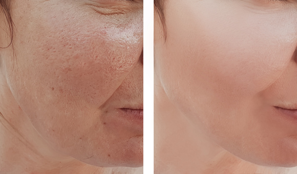 женщина морщит лицо до и после процедур
 - Фото, изображение