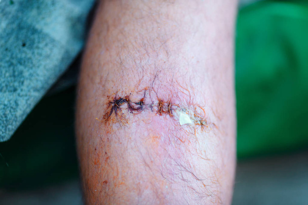 a ferida costurada em uma perna masculina
 - Foto, Imagem