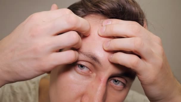 Κοντινό πλάνο φωτογραφία του νεαρός άνδρας ψάχνει για acnes στο πρόσωπό του - Πλάνα, βίντεο