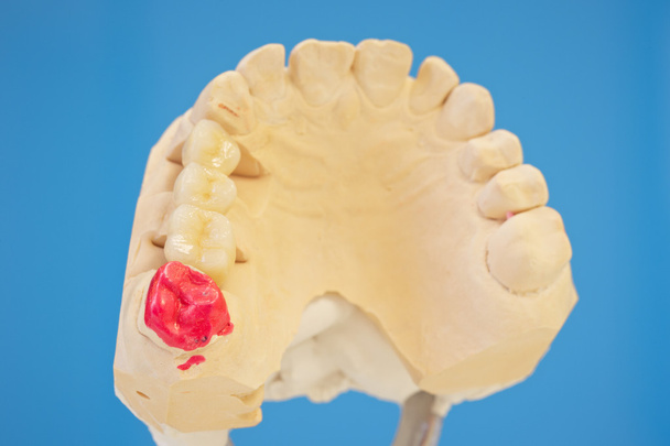 Modelo con prótesis dentales
 - Foto, Imagen