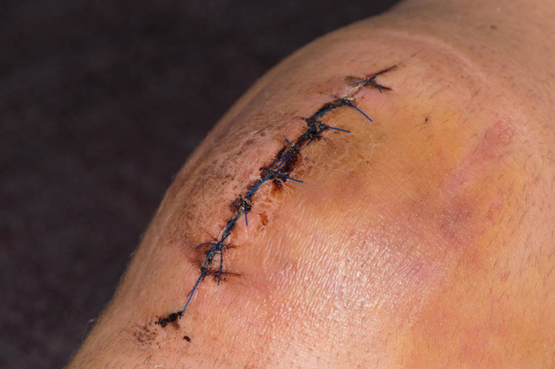 Ginocchio maschile dopo l'intervento chirurgico, sostituzione del ginocchio. Chirurgia del ginocchio in ospedale
 - Foto, immagini