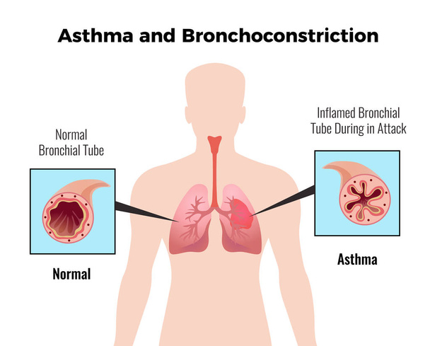Plakat medyczne astmy  - Wektor, obraz