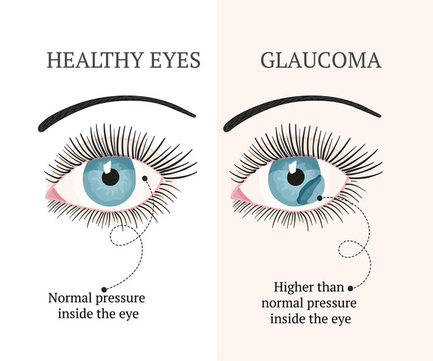 Malattia agli occhi. Illustrazione della salute oftalmologica
. - Vettoriali, immagini