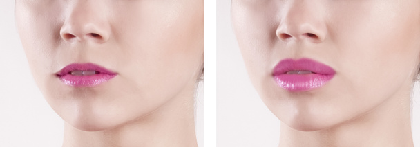 lips before and after augmentation - Photo, Image