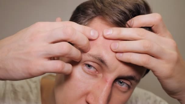 young man squeezing a pimple - Footage, Video