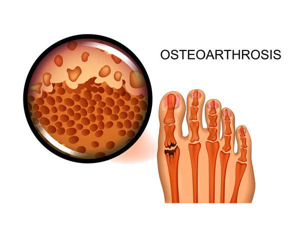 vektoros illusztráció az artrózis a nagy lábujj közös megsemmisítése - Vektor, kép