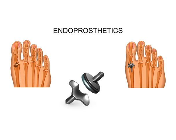 ilustración vectorial de artroplastia completa de la articulación del dedo gordo del pie
 - Vector, Imagen