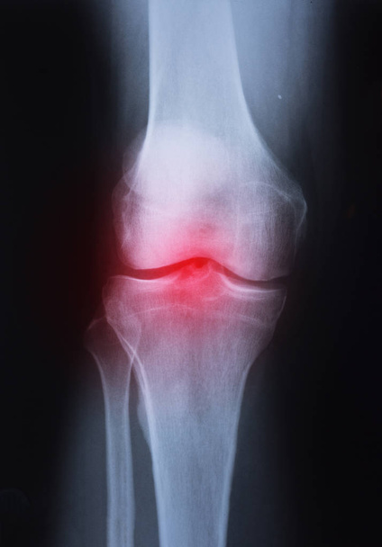 medizinisches Röntgenbild des Kniegelenks bei Arthritis (Gicht, rheumatoide Arthritis, septische Arthritis, Arthrose Knie) ) - Foto, Bild