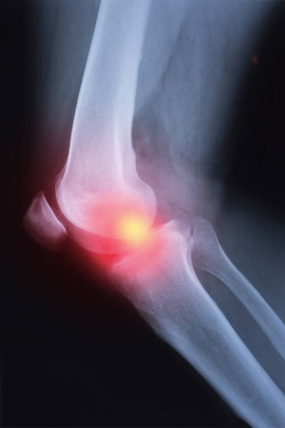 Imagen de la articulación de la rodilla de rayos X médicos con artritis (gota, artritis reumatoide, artritis séptica, osteoartritis rodilla)
 ) - Foto, imagen