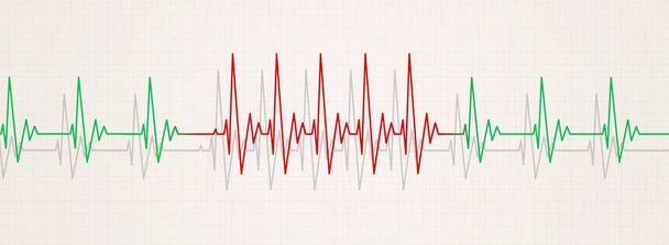 banner de medicina que ilustra arritmia súbita. ritmo cardíaco aumentando más de 90 latidos por minuto
 - Foto, imagen