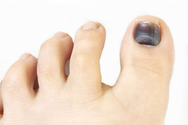 Subungual hematoma blue and black toe nail - Photo, Image