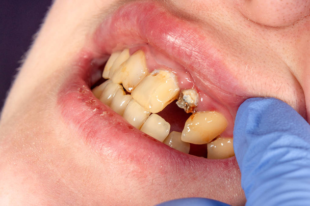 Pino dentário close-up, preparação do dente para a formulação da coroa de cerâmica. O conceito de prótese na odontologia
 - Foto, Imagem