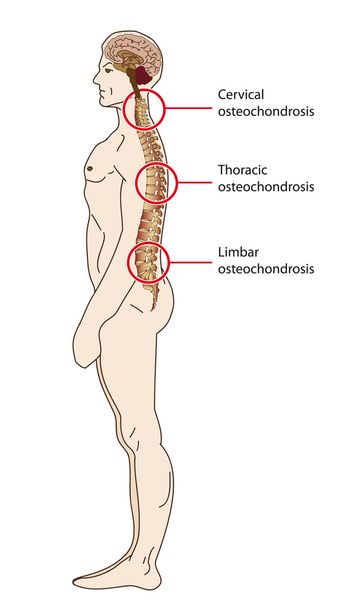 spinal osteochondrosis - Vector, Image