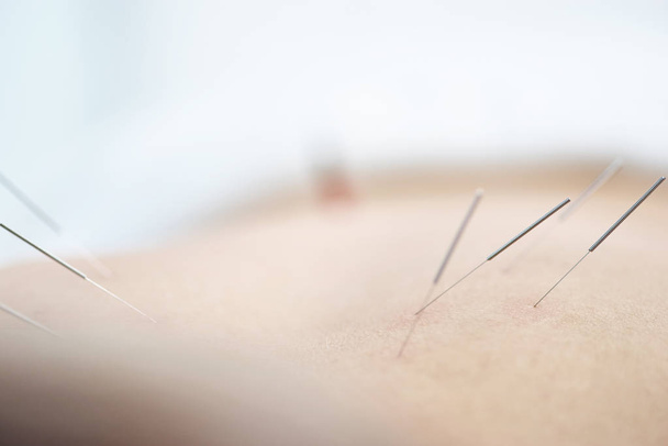 Alternative medicine. Close-up of female back with steel needles during procedure of acupuncture therapy. - Foto, immagini