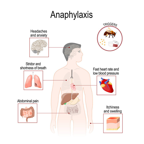 Anafylaksia on vakava allerginen reaktio, joka voi aiheuttaa kuoleman. Ihmisen siluetti korostettu sisäelimiä. Vektorin havainnollistaminen lääketieteelliseen, biologiseen ja opetuskäyttöön
 - Vektori, kuva