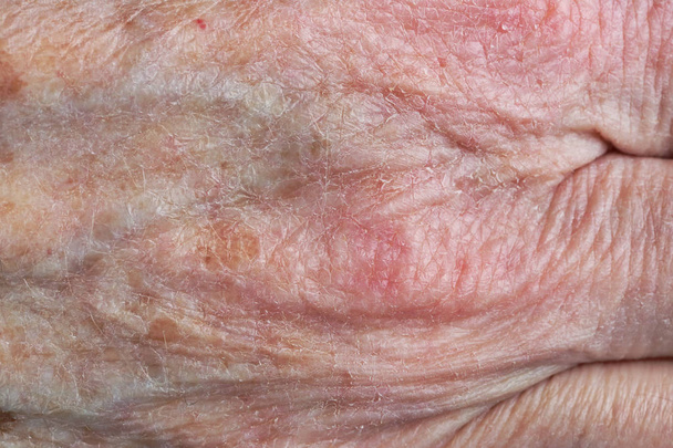 Sore dry skin on the hand of an old woman grandmother. Studio macro shot - Photo, Image