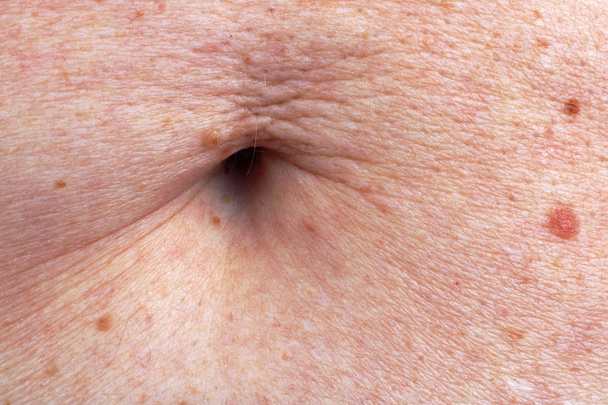 Het oppervlak van de huid van de maag en de navel van de bejaarde oude vrouw. Een heleboel mollen, vlekken en littekens van zijn afgesneden van wratten. Studio macro schot - Foto, afbeelding