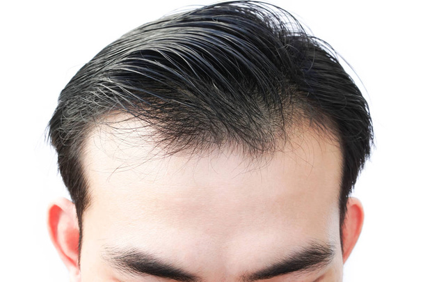 Nuori mies vakava hiustenlähtö ongelma terveydenhuollon lääketieteen ja shampoo tuotekonsepti - Valokuva, kuva