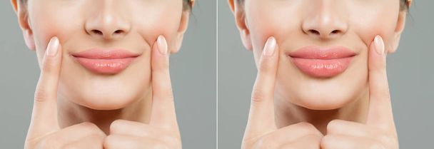 Kobiece usta. Usta kobiety przed i po iniekcji wypełniacza wargi. Powiększenie wąskich warg - Zdjęcie, obraz