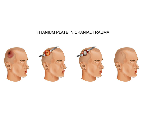 illustrazione vettoriale della lastra di titanio in lesioni cerebrali traumatiche
 - Vettoriali, immagini