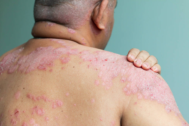Patient is holding shoulder wound. Diseases caused by abnormalities of the lymph. Psoriasis is a skin disease. Select focus shallow depth of field - Photo, Image