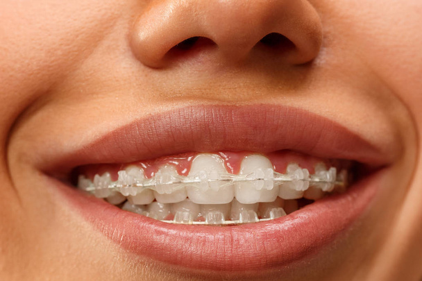 Gyönyörű fiatal nő, fogak fogszabályozó - Fotó, kép