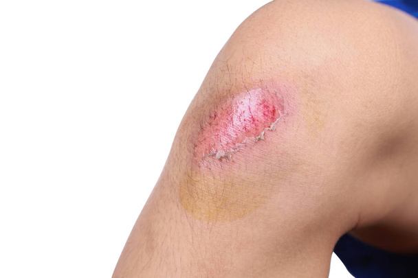 Aziatische jongen kreeg ongeval pijnlijke wond, geschraapt of gewond op knie in het voetbal spel. Close up van bloeden geschraapt na uitvoering ongeval geïsoleerd op witte achtergrond. - Foto, afbeelding