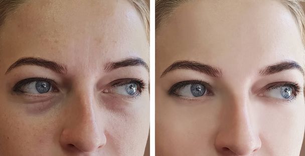 chica arrugas ojos antes y después de los procedimientos
 - Foto, imagen
