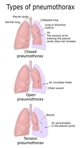 Illustration de trois types de pneumothorax - fermé, ouvert et en tension
 - Vecteur, image