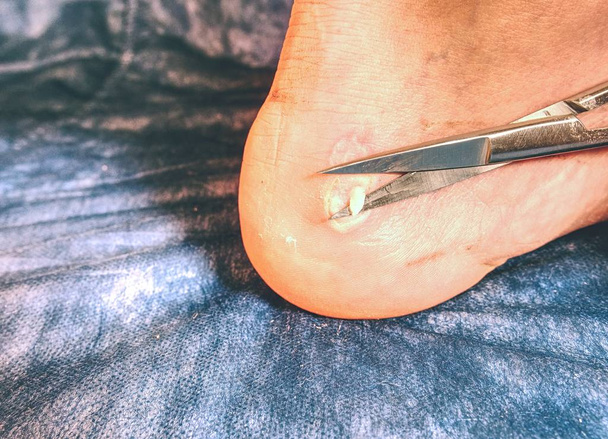 Mediciman treat damaged skin on sportsman heel.  Nasty hot place of damaged skin near Achilles tendon - Photo, Image