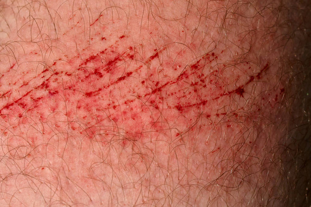 Scratch skin, wound or cut on the skin, red blood. Hairy part of a man body close-up. - Photo, Image