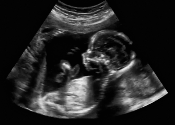 Obstetric ultraääni ultraääni ultraääni Ekografia ensimmäisen kuukauden
 - Valokuva, kuva