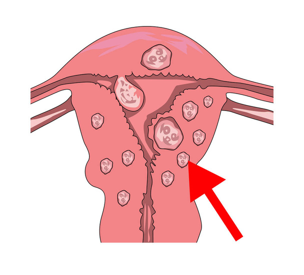 子宮筋腫。子宮筋腫と痛みの点へのポインターを. - ベクター画像