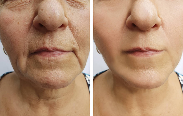 ηλικιωμένη γυναίκα ρυτίδες πρόσωπο πριν και μετά τη διαδικασία - Φωτογραφία, εικόνα