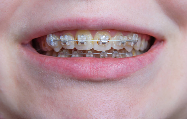 Kızın yüzü açık ağız ve diş teli dişlerini üzerinde parçası. Ayrıntılar diş diş teli ile - Fotoğraf, Görsel