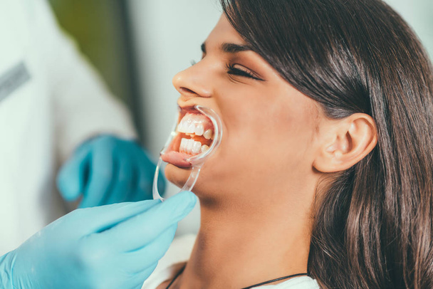  Молода жінка має процедуру відбілювання зубів
 - Фото, зображення