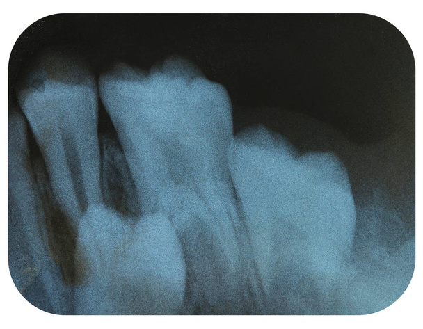 X-Ray negatywu zderzanie zęba - Zdjęcie, obraz