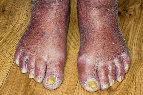 Infección por hongos en las uñas del pie de hombre
 - Foto, imagen
