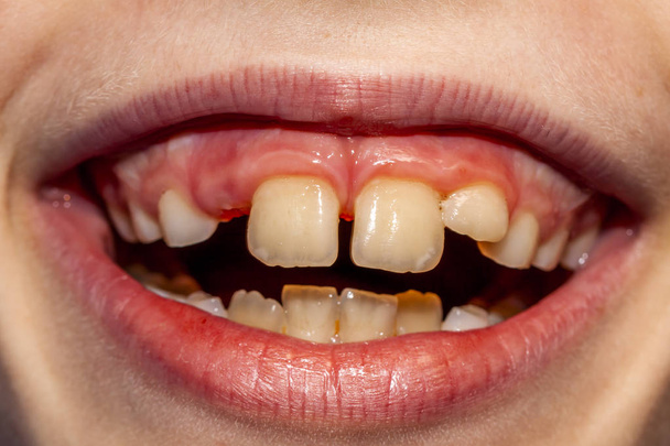 Gros plan de l'enfant de huit ans avec le problème de ne pas perdre ses dents de bébé 10 mois après le traitement - dents de bébé persistantes, également appelées maladie du requin - après l'opération retrait des dents de lait
 - Photo, image