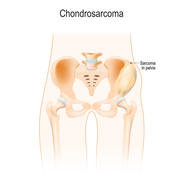 Chondrosarcoma kıkırdak hücrelerden bir kanserdir. malign bir neoplazma. Bel bölgesi. Kalça, omur ve leğen kemiği anatomisi. Vektör çizim biyolojik, bilim, tıbbî kullanım için. - Vektör, Görsel