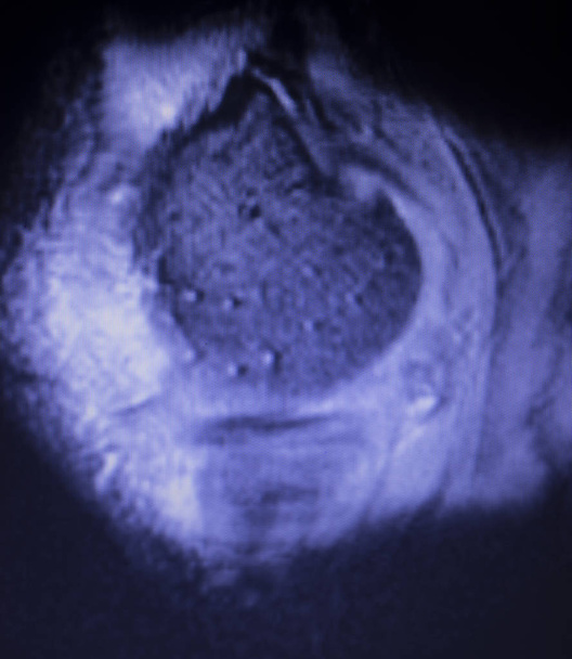 Μαγνητική τομογραφία Mri γόνατο οπισθίου κέρατος έσω μηνίσκου δάκρυ scantest αποτελέσματα. - Φωτογραφία, εικόνα