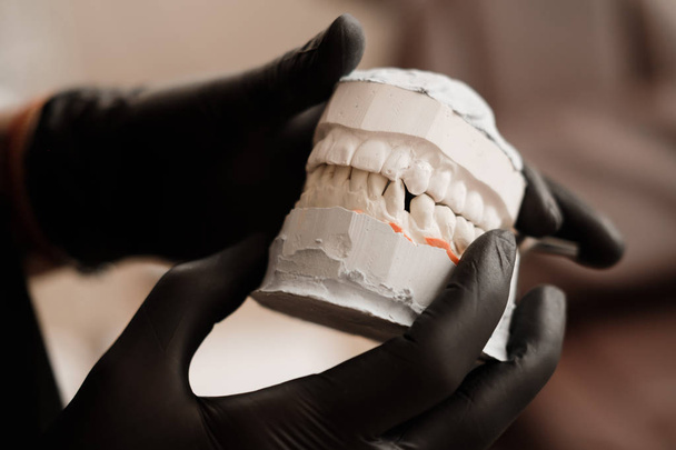 Sádrový odlitek čelistí. Zubař v černé rukavice držící zubní odlévání sádry model lidské čelisti v protetické laboratoři. Stomatologie, ortodoncie. Zblízka. Selektivní fokus - Fotografie, Obrázek