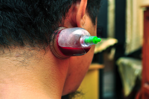 Blood in medical cupping therapy cup - Photo, Image