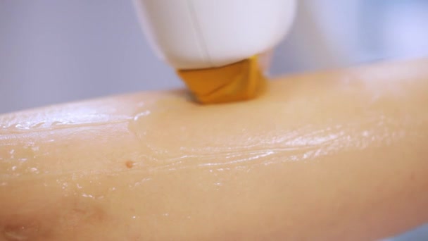 Macro close-up procedure of laser hair removal on a diode laser - Footage, Video